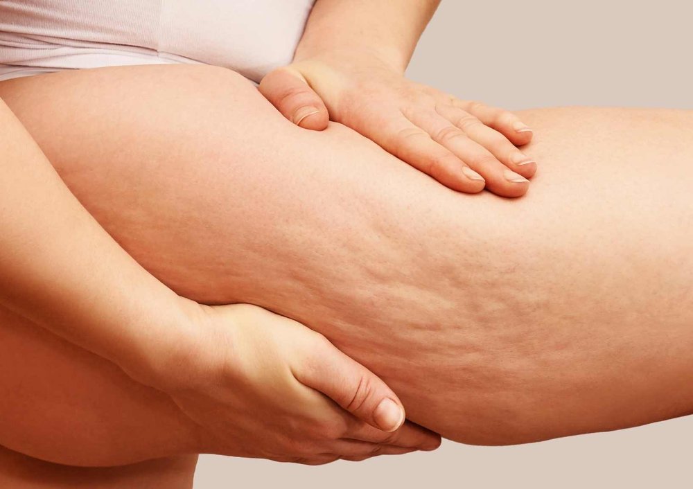 Can you get rid of cellulite? 