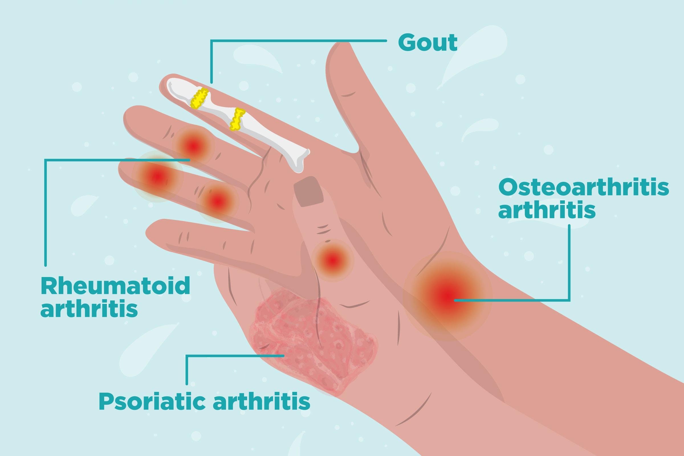 Arthritis موقع معلومه صحيه