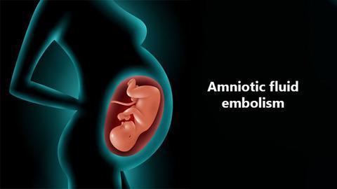amniotic fluid embolism pdf